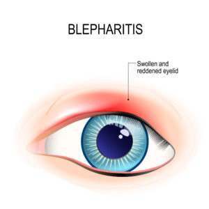xronia_blefaritida