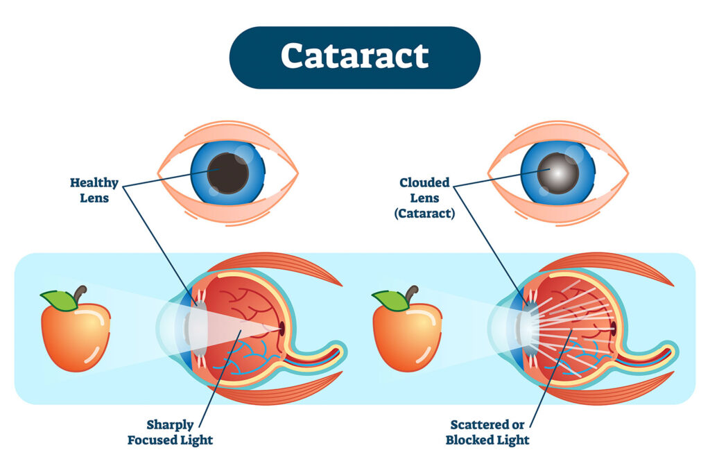 cataract