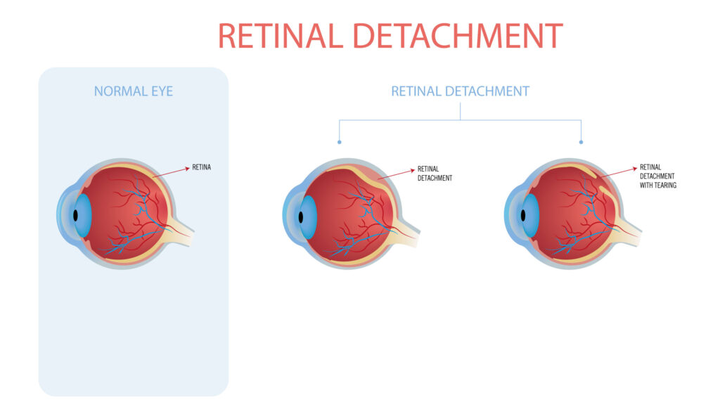 retina detachment