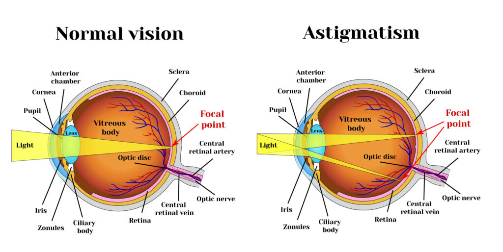 astigmatism