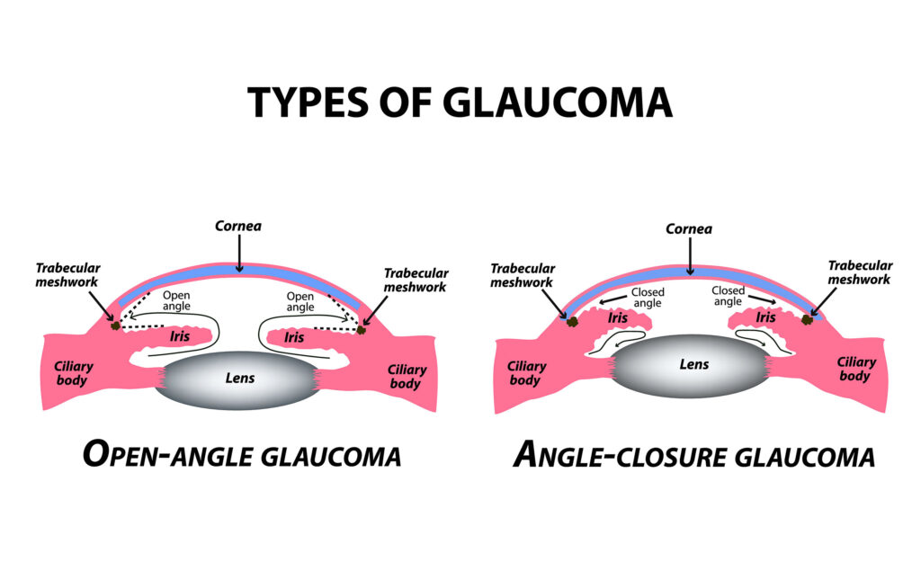 glaucoma_types