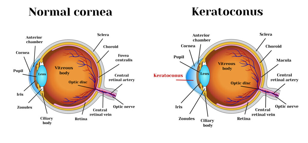 keratoconus