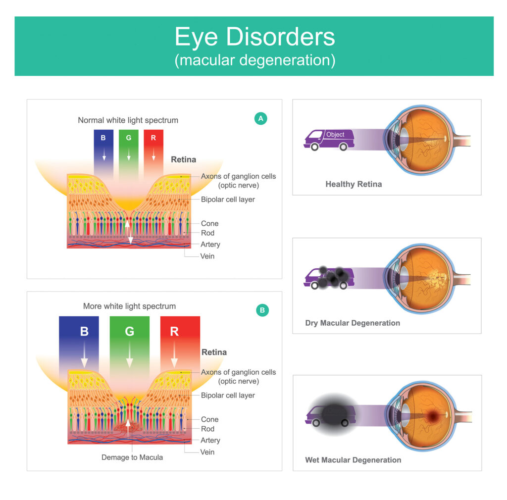 macular_disorder