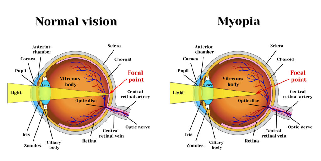 myopia