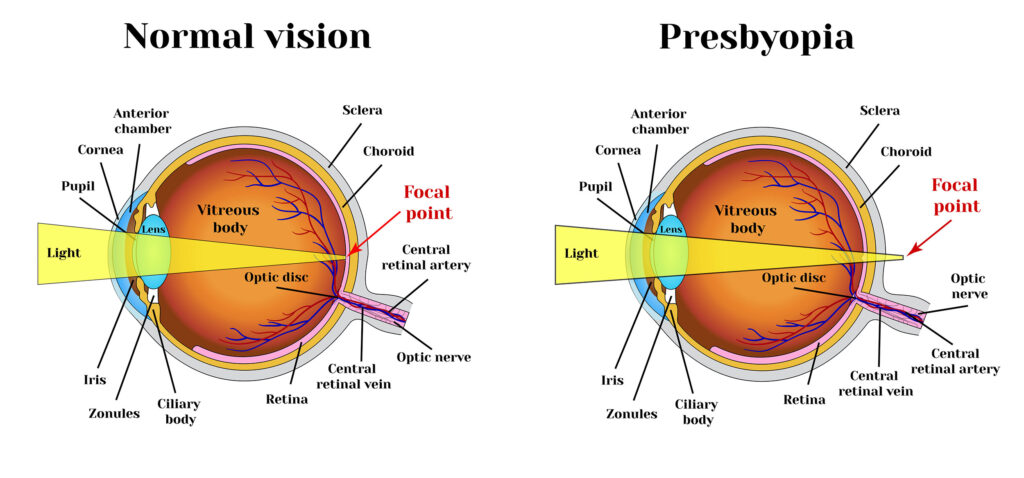 presbyopia